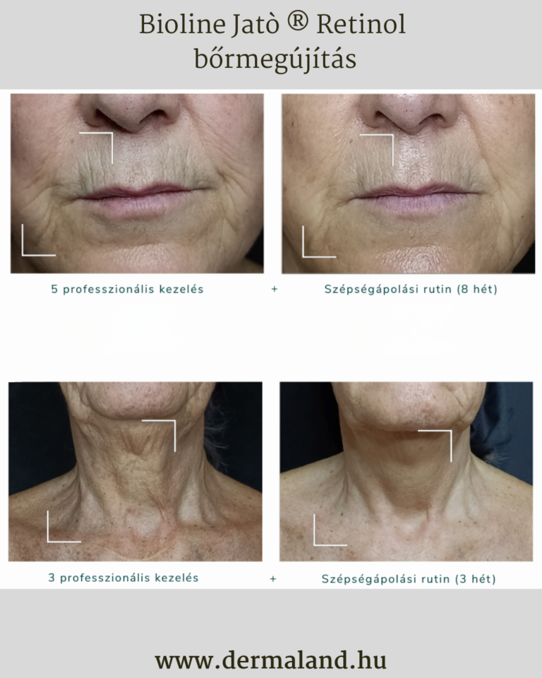 retinolos-arcfiatalítás-mezoterápia-masszázs-biolinejató-dermaland-kecskeméti-kozmetika-kozmetikus-öregedő-megereszkedett-ráncos-bőrre-dermapen
